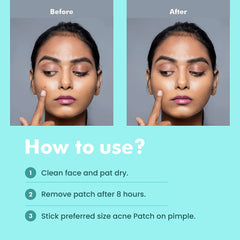 FemiSafe Acne Pimple Patch | 24 Invisible Waterproof 2% Salicylic Acid & Hydrocolloid Spot Acne Patches for Men & Women